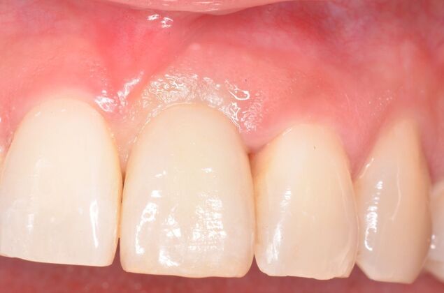 Dental Implants: Case 56 - Final implant crown