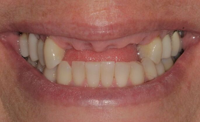 Dental Implants Case 11 - Before