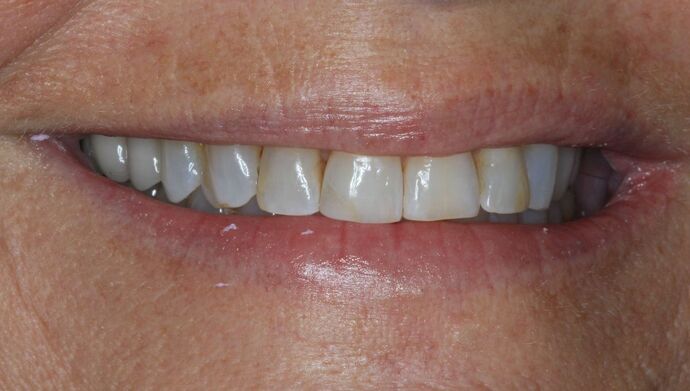 Full Mouth Reconstruction: Case 28 - Before