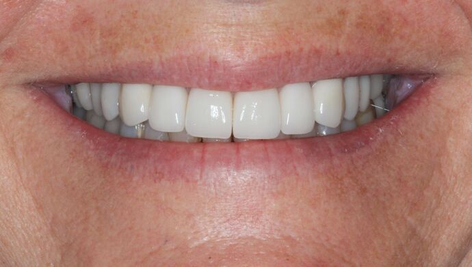 Full Mouth Reconstruction: Case 28 - After