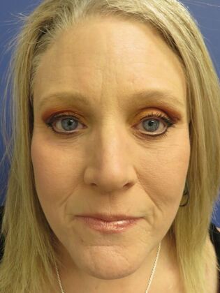 Facelift / RestoreLift Case 21 - After