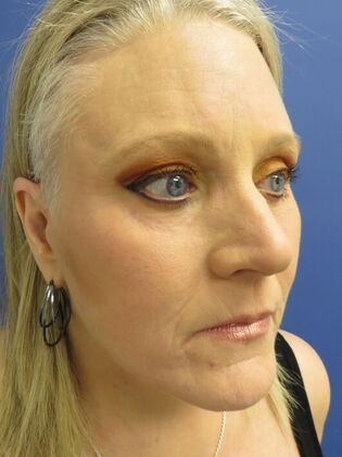 Facelift / RestoreLift: Case 21 - After