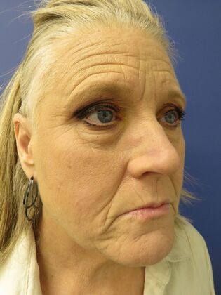 Facelift / RestoreLift: Case 21 - Before