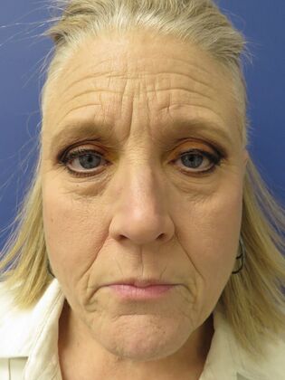 Facelift / RestoreLift Case 21 - Before