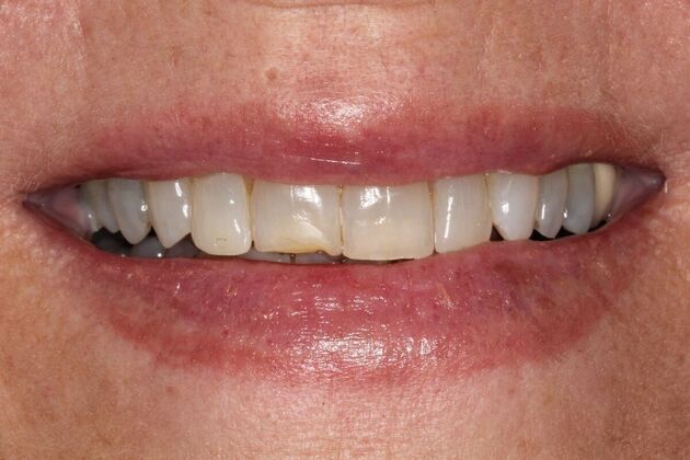 Full Mouth Reconstruction: Case 29 - Before
