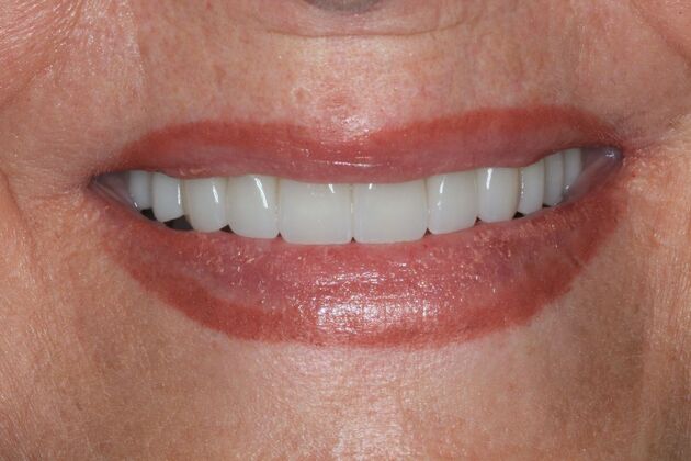 Full Mouth Reconstruction: Case 29 - After