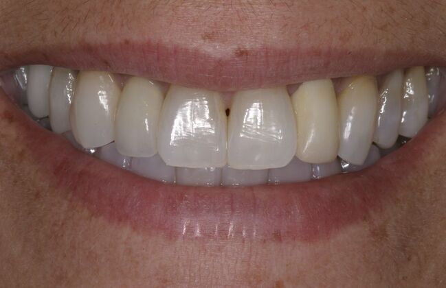 Full Mouth Reconstruction: Case 30 - Before