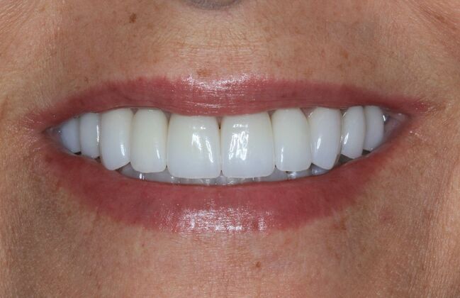 Full Mouth Reconstruction: Case 30 - After