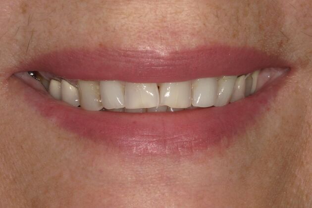 Full Mouth Reconstruction: Case 31 - Before