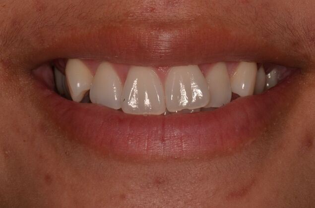 Invisalign: Case 20 - Smile before invisalign
