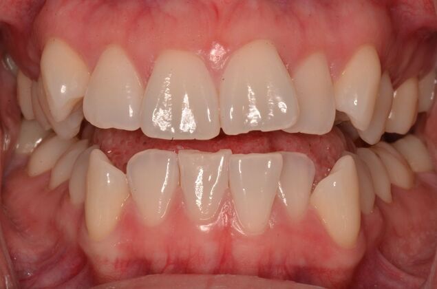 Invisalign: Case 20 - Before invisalign. Note the severe crowding.