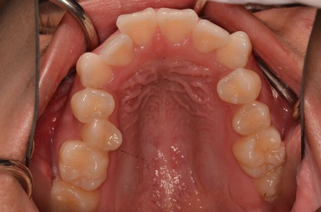 Invisalign: Case 20 - Before invisalign.  Notice how narrow the upper arch is.  