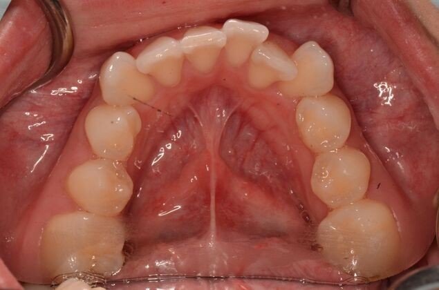Invisalign: Case 20 - Before invisalign
