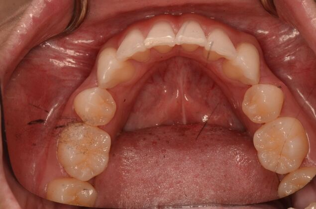 Invisalign: Case 20 - After invisalign (orthodontics)