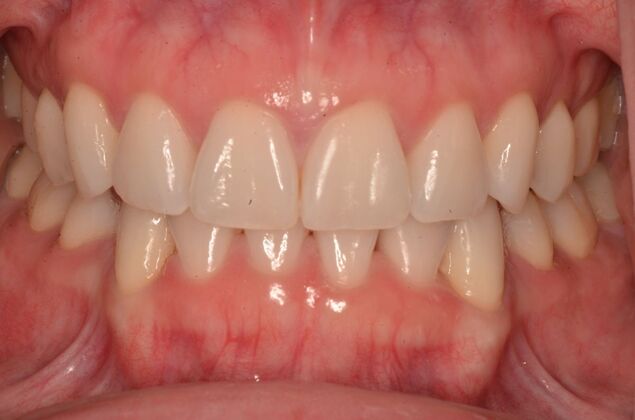 Invisalign: Case 20 - After invisalign (orthodontics)