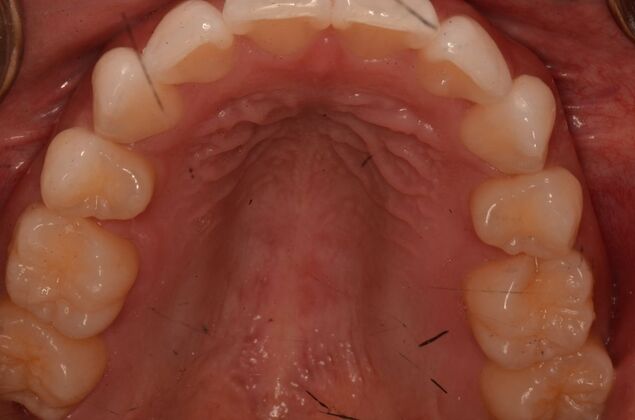Invisalign: Case 20 - After invisalign.  Notice the expanded upper arch.
