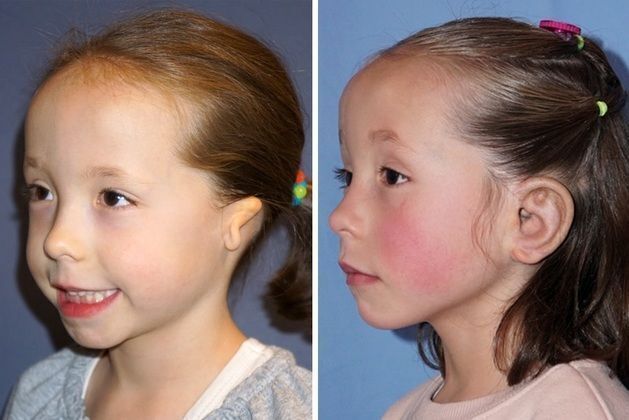 Combined Ear & Canal: Before & After