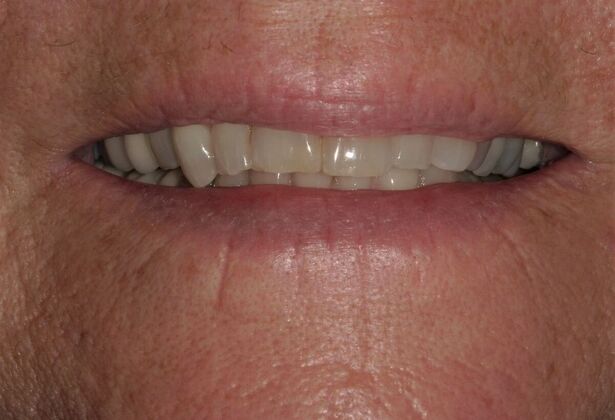 Full Mouth Reconstruction: Case 32 - Before