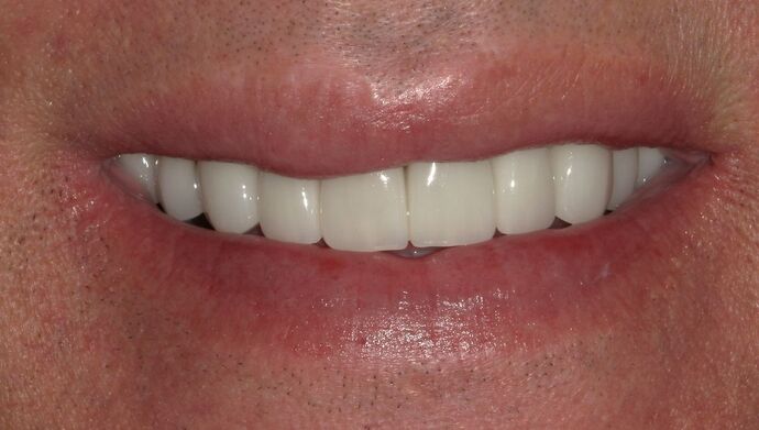 Full Mouth Reconstruction: Case 33 - After