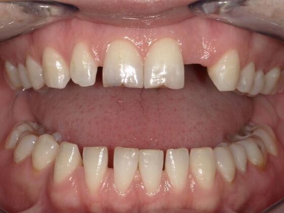 Dental Bridge Case 1 - Before