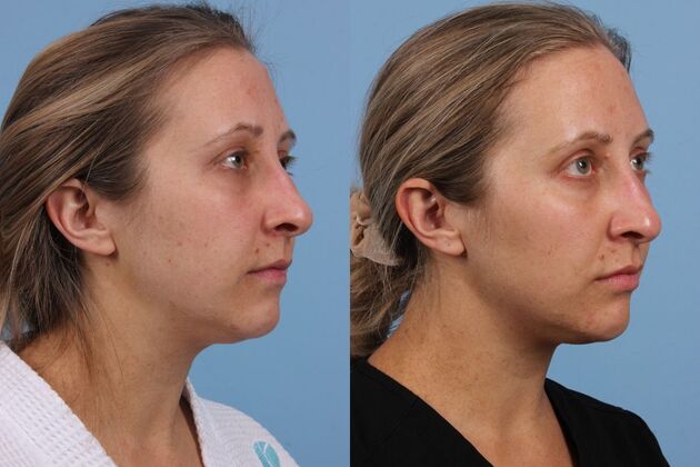 Little Rock Cosmetic Injectables And Fillers Before And After Gallery