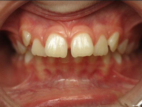 Smile Makeover Case 1 - Before