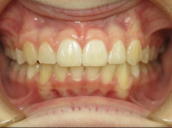 Smile Makeover Case 1 - After