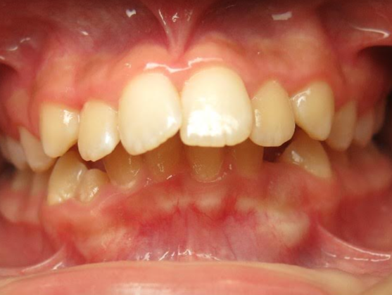 Smile Makeover Case 2 - Before