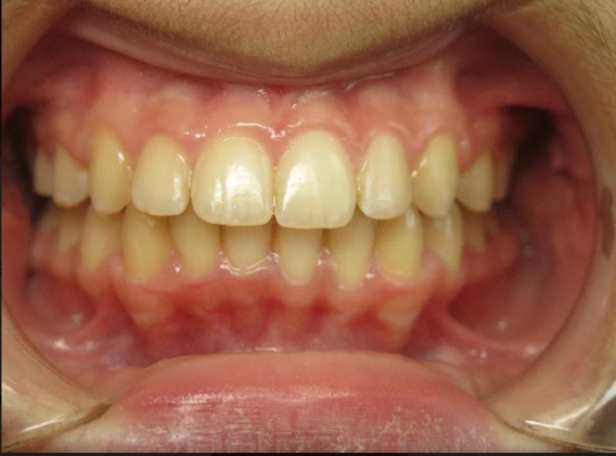 Smile Makeover Case 2 - After