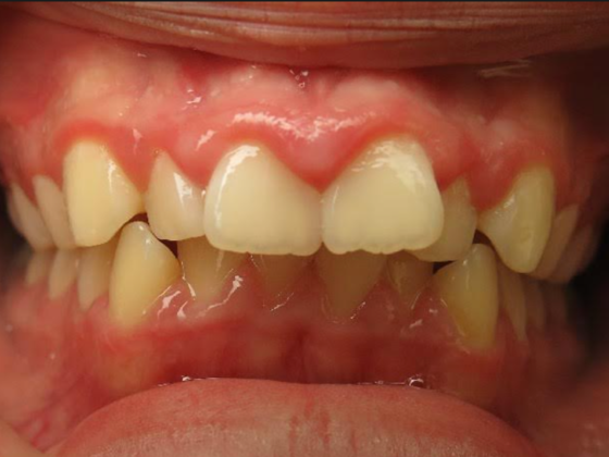 Smile Makeover Case 4 - Before