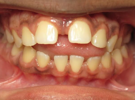 Case 5 Smile Makeover Before And After Gallery