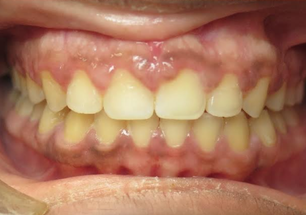 Smile Makeover Case 5 - After