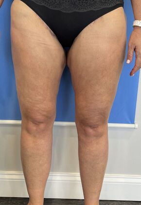 Thigh Lift: Case 5 Thigh Lift with Liposuction, Cheshire, CT - After