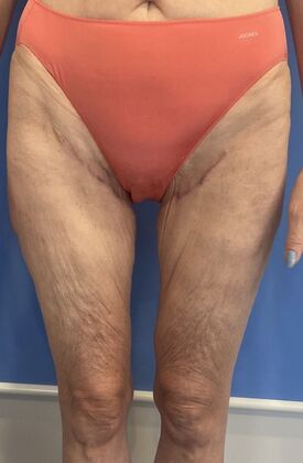Thigh Lift Case 6 Thigh Lift, Greenwich, CT - After