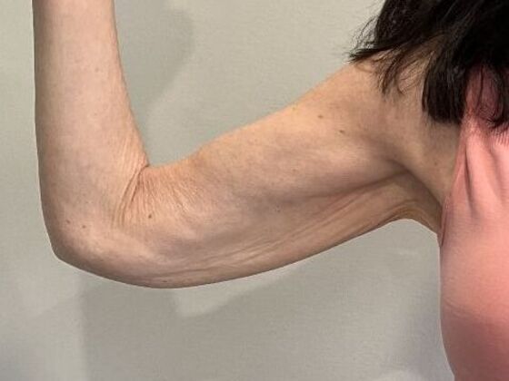 Arm Lift: Case 6 Upper Arm Lift, Darien - Before