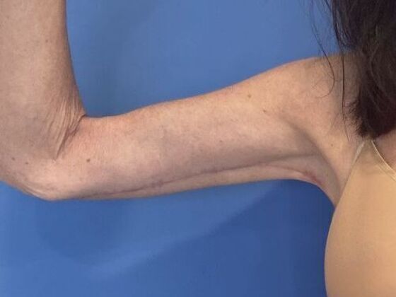 Arm Lift: Case 6 Upper Arm Lift, Darien - After