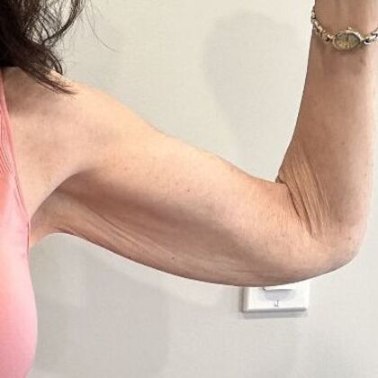 Arm Lift: Case 6 Upper Arm Lift, Darien - Before