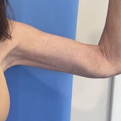 Arm Lift: Case 6 Upper Arm Lift, Darien - After