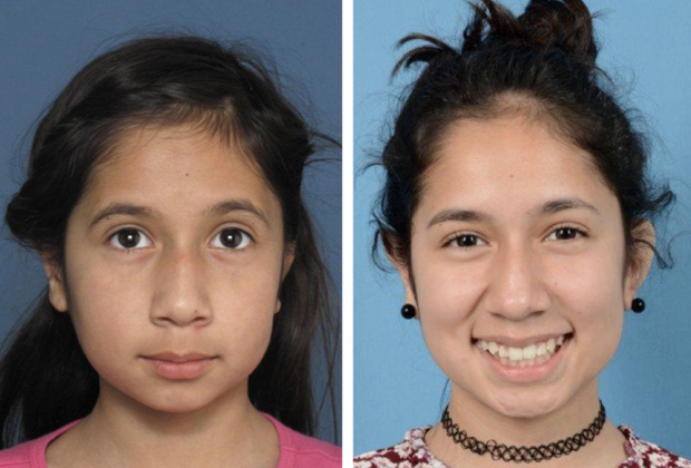 Correcting Prior Surgeries: Before & After - Left ear after a prior unsatisfactory surgery & after one corrective surgery.