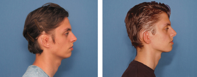 Correcting Prior Surgeries: Before & After