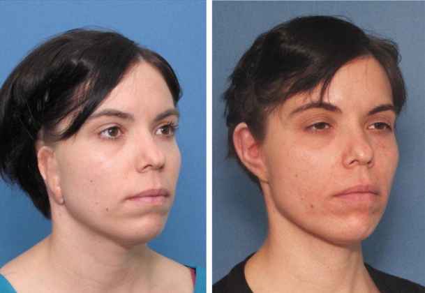 Correcting Prior Surgeries: Before & After - Right ear after 4 prior unsatisfactory, cartilage surgeries & after a single revision.