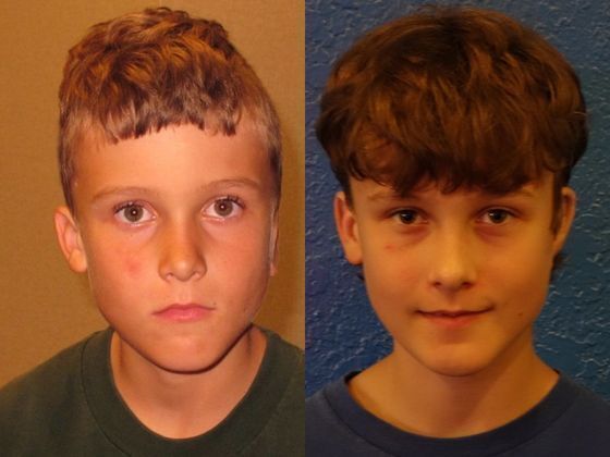 Correcting Prior Surgeries: Before & After - 9yr. old with 4 prior surgeries & after one Medpor revision.