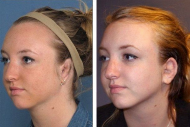 before-after-correcting-prior-surgeries-before-and-after-gallery