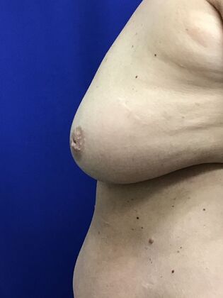 Breast Nipple & Areola : Case 8 - Before, lacking projecton