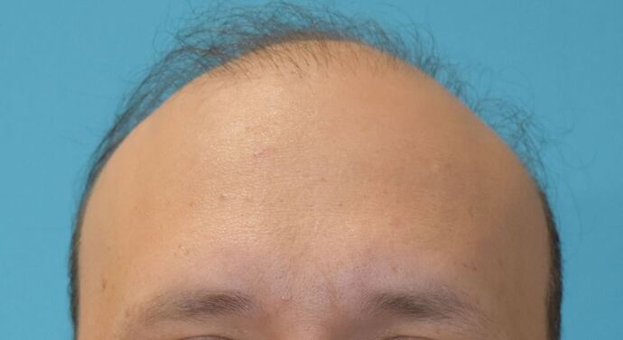 Hair Transplantation Case 1 - Before