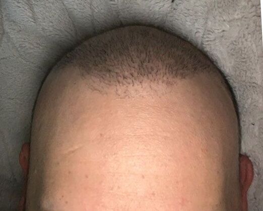 Hair Transplantation Case 1 - After
