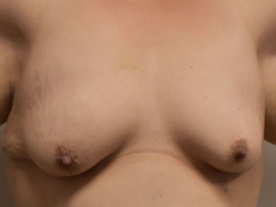 Breast Augmentation w/ Lift Case 432 - Before