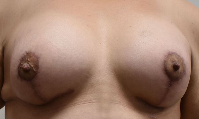 Massive Weight Loss : Case 104 - After