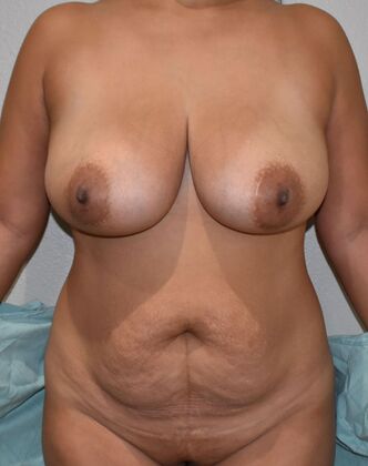 Mommy Makeover Case 235 - Before