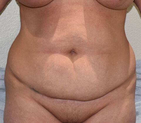 Tummy Tuck (Abdominoplasty): Case 361 - Before